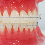 大人(成人)の矯正歯科